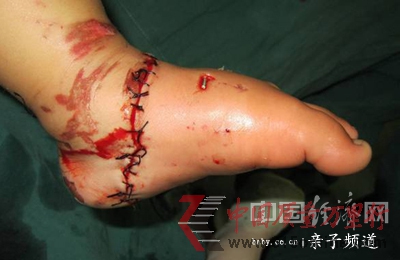 電瓶車(chē)咬斷女童左腳醫(yī)生呼吁強(qiáng)制安裝防護(hù)網(wǎng)(圖)
